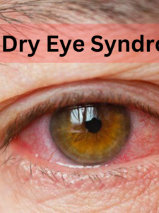 dry-eye-syndrome