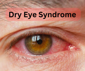 dry-eye-syndrome