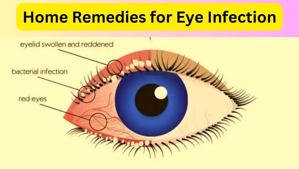 Home Remedies for Eye Infection