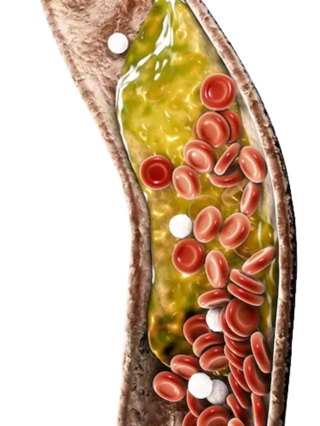 Understanding High Cholesterol A Quick Guide