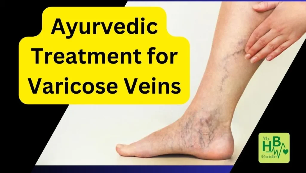Ayurvedic Treatment for Varicose Veins